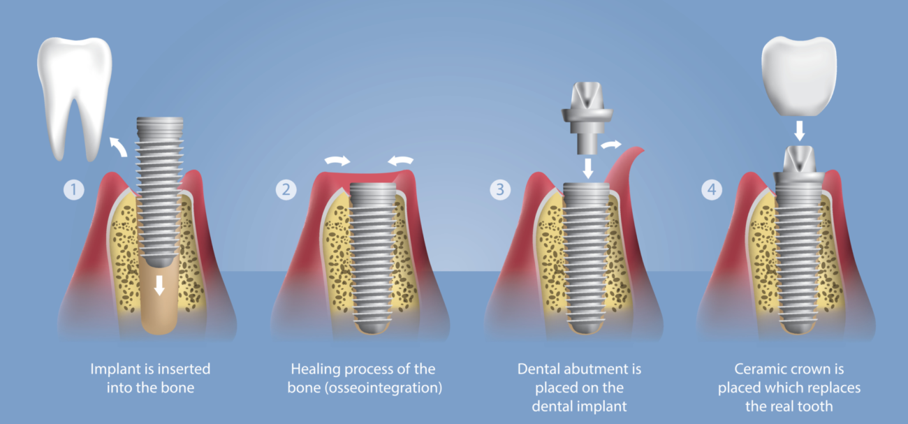 dental implant process diagram manassas va implant dentist office 