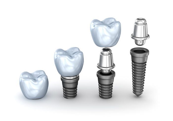 dental implant components at Manassas VA dentist office