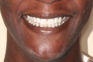 patient 3 after porcelain veneers at Manassas Smiles