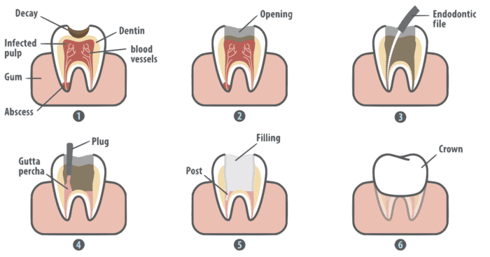 Root canal treatment diagram