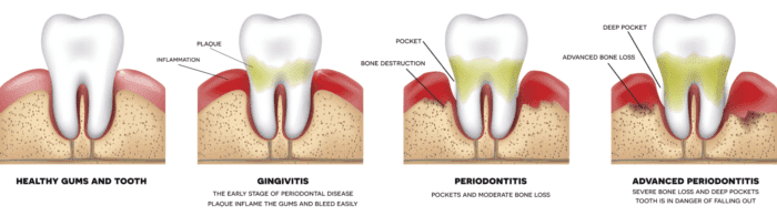 gum-disease-progression manassas smiles va