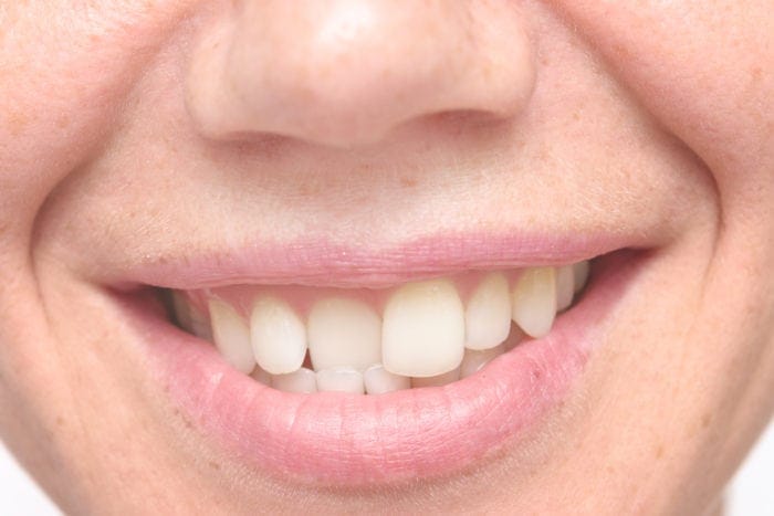 Top 5 Asked Questions About Invisalign Manassas VA