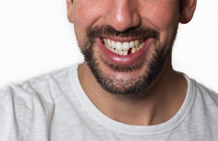 Replacing Missing Teeth Manassas VA