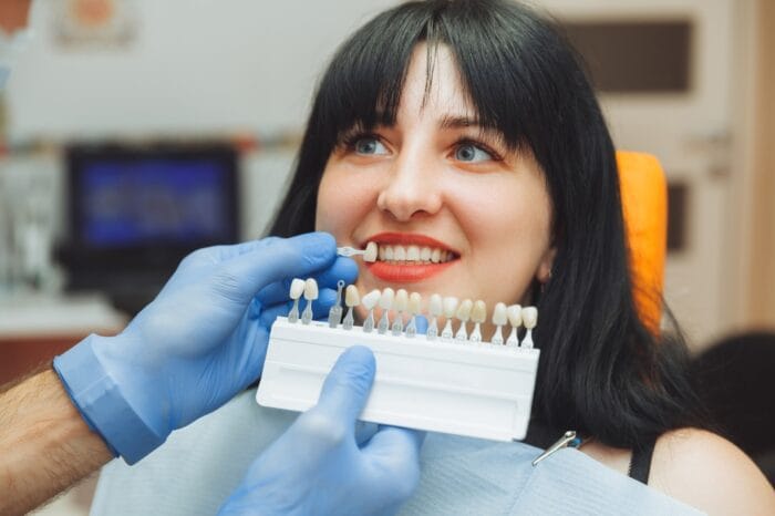 veneers