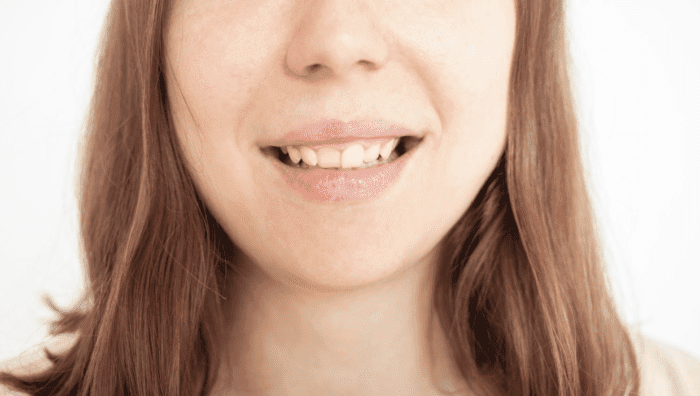 woman with stained teeth
