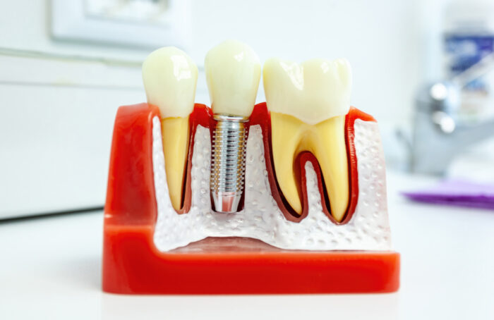 Tips on Avoiding Common Dental Implant Problems