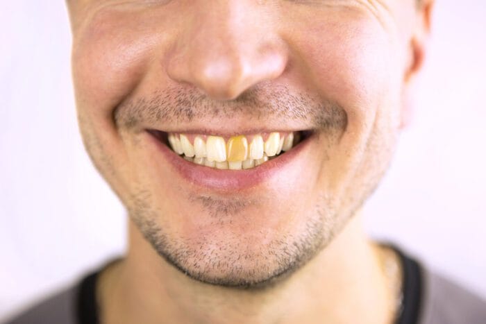 Yellow damaged tooth of a smiling Caucasian man in close-up. Foc
