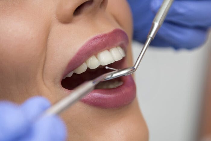 Veneers