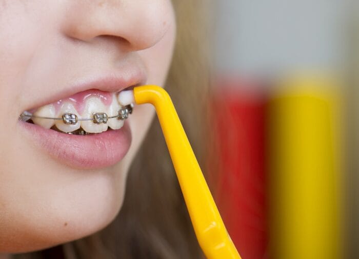 braces