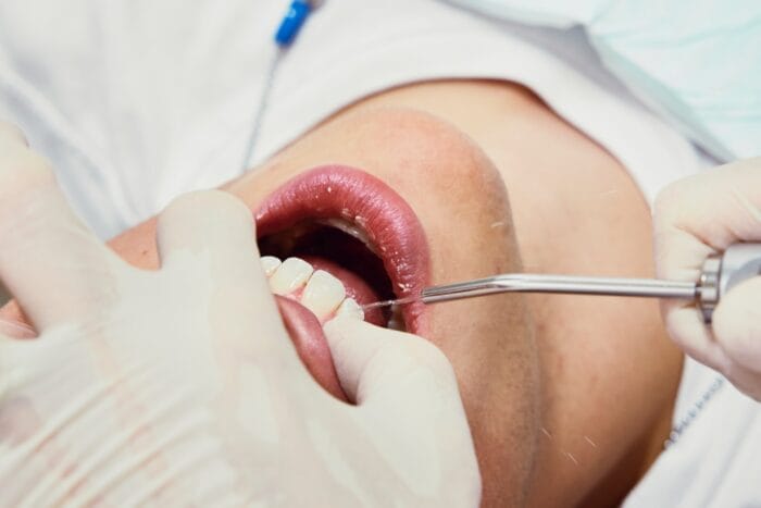 Dental Crowns