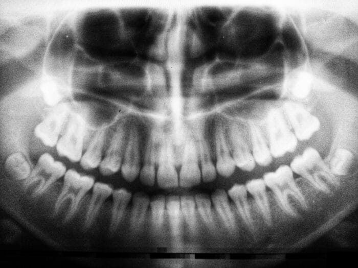x-ray