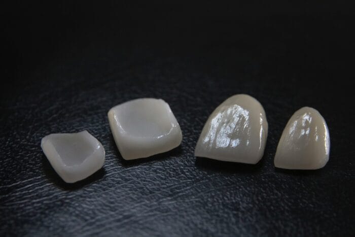veneers