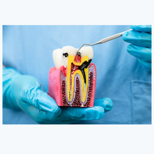 root canal therapy in manassas