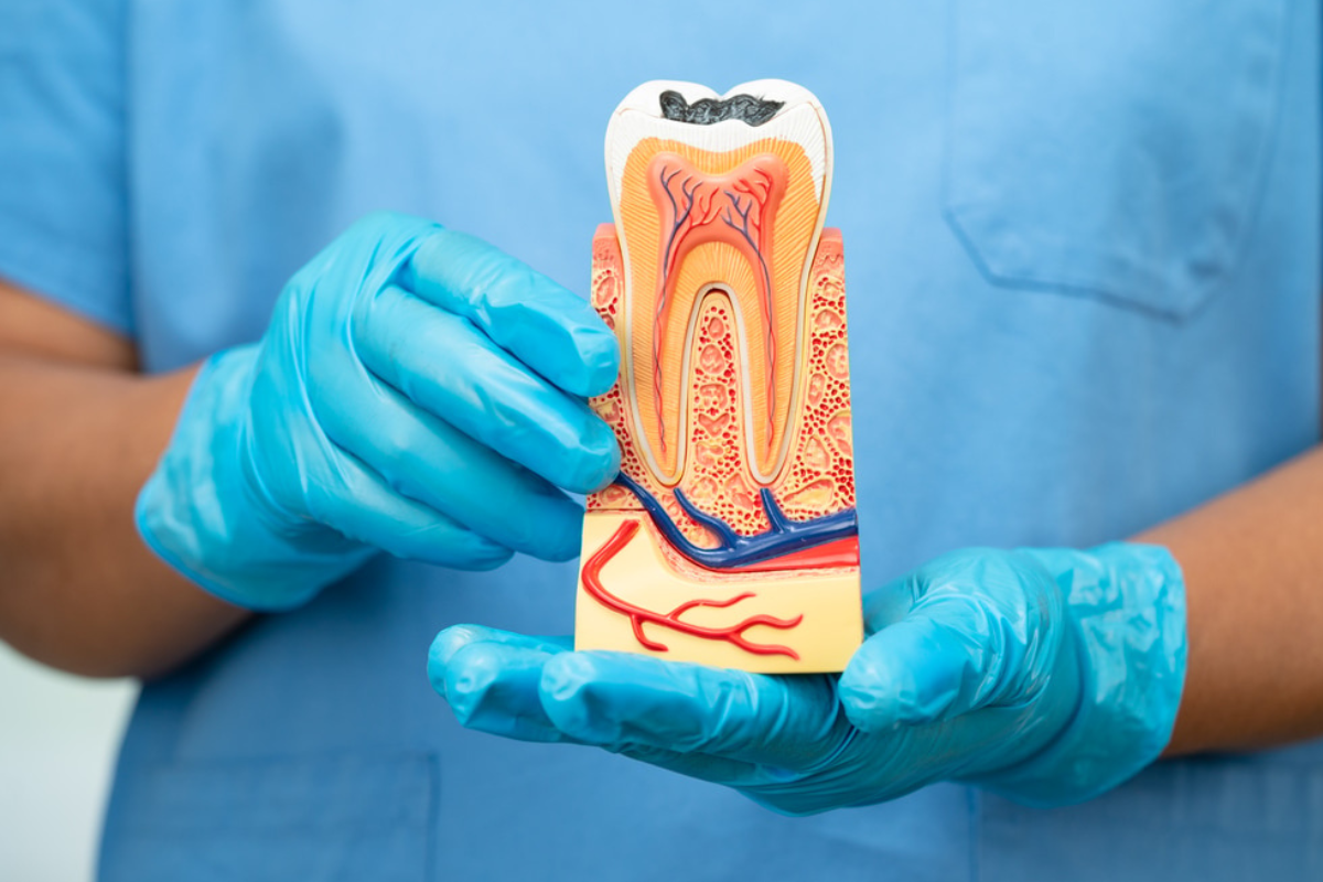 Tooth Root Completion Save Your Natural Tooth with Root Canal Therapy