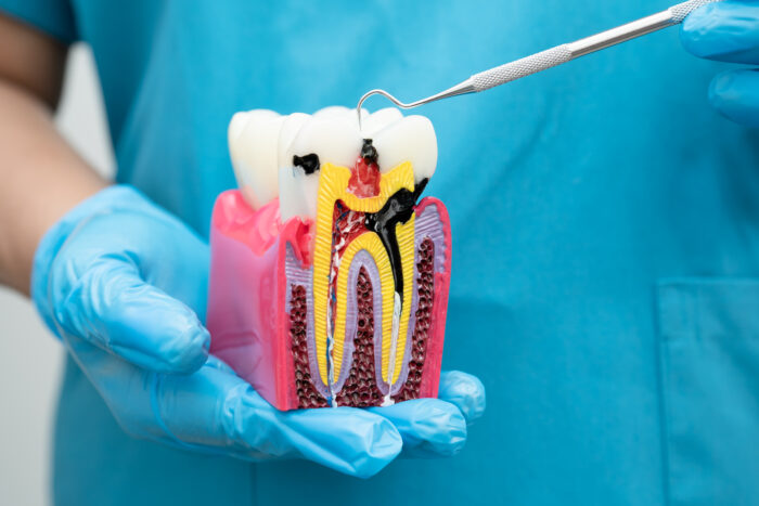 Can a Root Canal Save My Tooth?