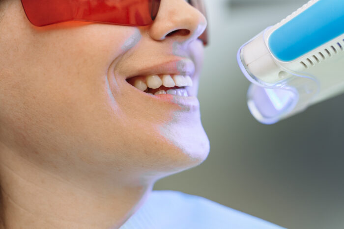 What Foods Should You Avoid After Teeth Whitening?