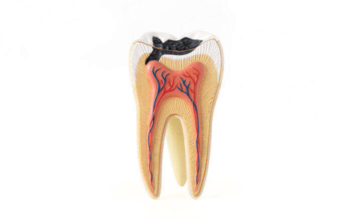 How to Care for Your Tooth After a Root Canal