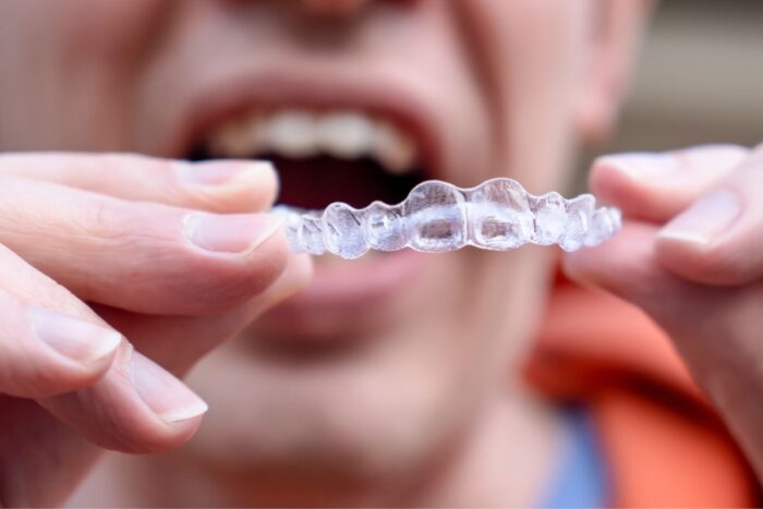 Is Invisalign a Permanent Fix?