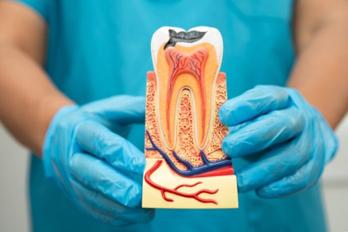 Dental root canal