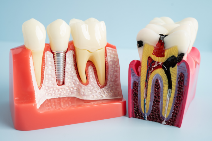 root canal therapy manassas