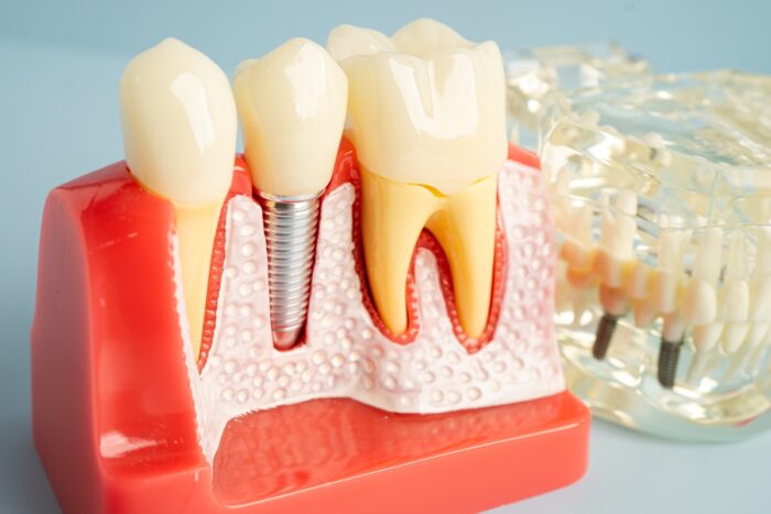 digital imaging for dental implants