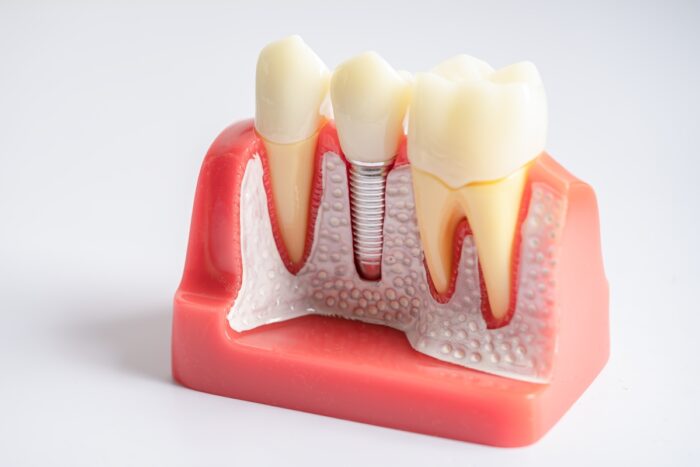 Bad Breath After Dental Implants