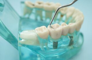 Dental Bridges in Manassas