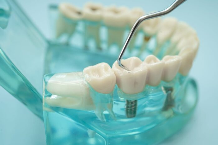 Dental Bridges in Manassas